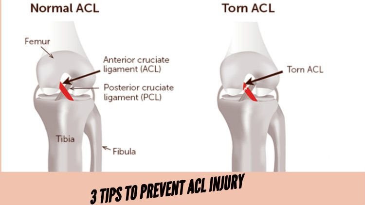 Stretches to prevent an anterior cruciate ligament injury