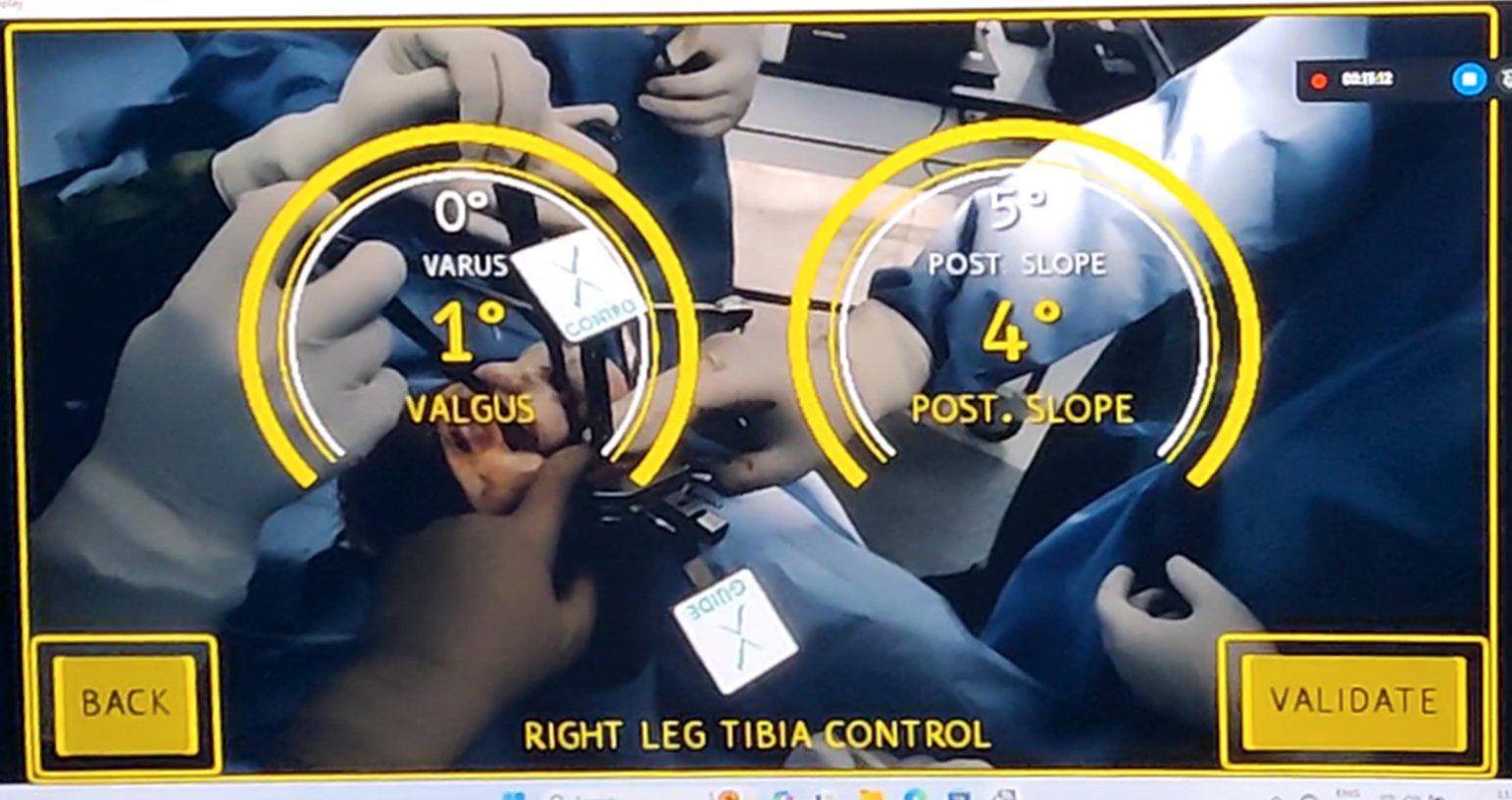 Augmented Reality (AR) Technology in Knee Replacement Surgery Dr
